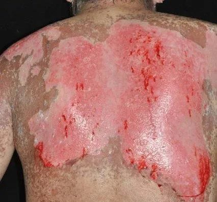 常见的严重过敏反应有:史提芬强生症候群(stevens-johnson syndrome