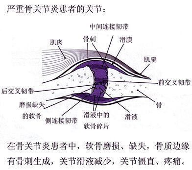骨质|这种病可致残，虽无法根治，但可以有效预防！