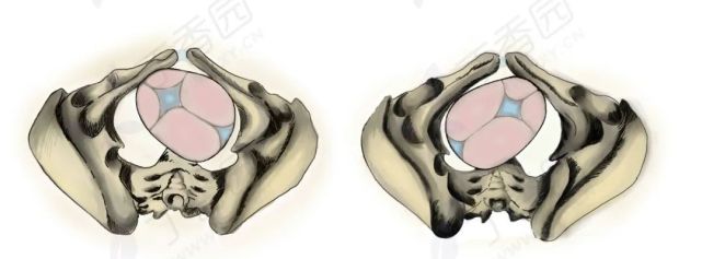 枕部位于母体骨盆的后方,表现为左枕后位或者右枕后位,图 1,矢状缝在