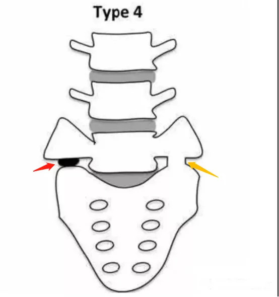 横突|腰骶骨移行椎，你是如何判断的？