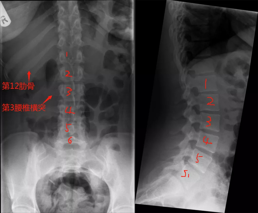 横突|腰骶骨移行椎，你是如何判断的？