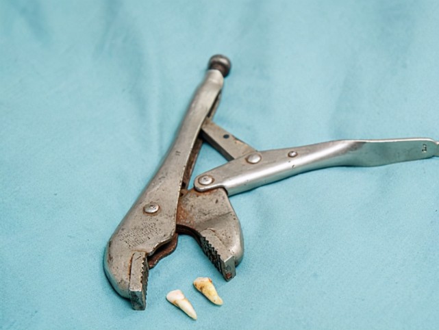 英男子疫情期间总约不到牙医竟疼得拿钳子拔牙拔完瞬间后悔