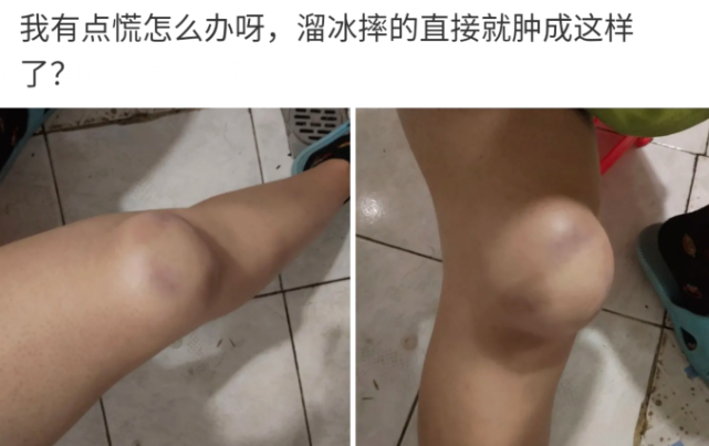 有点慌溜冰摔的膝盖鼓起一个大包哈哈哈这也太惨了