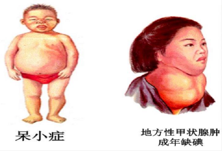 新生儿呆小症图片图片