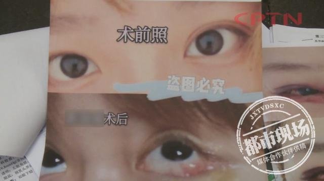 想要眼睛更大 女子整形术后悔不当初 我现在哭都不敢哭 腾讯新闻