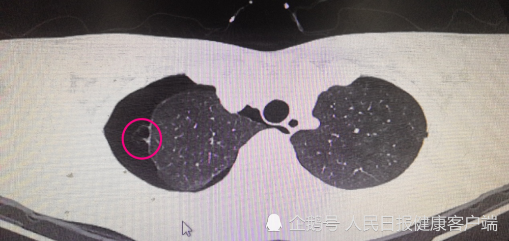 随后到武汉肺科医院进行复查,经大夫诊断为肺大疱破裂发生气胸,所幸