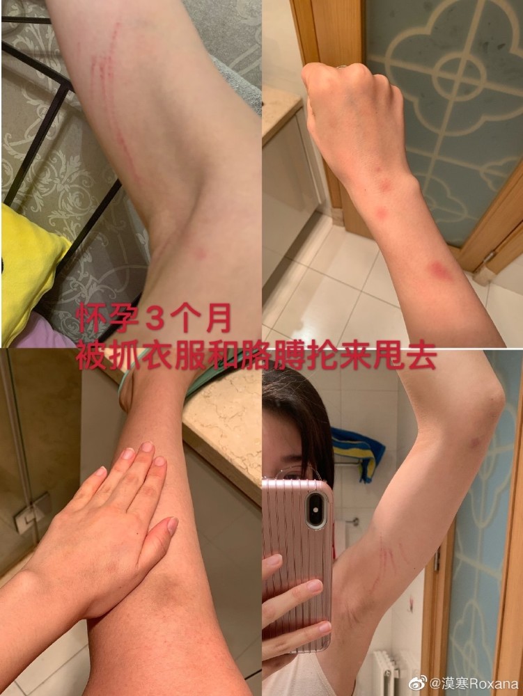 中国飞人孕期家暴出轨美女解说控诉张培萌晒受伤照要求离婚