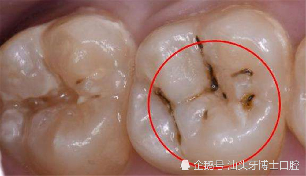 但是不痛不癢蛀牙,又稱齲(qu,第三聲)齒,根據蛀牙的深淺程度不同,可以