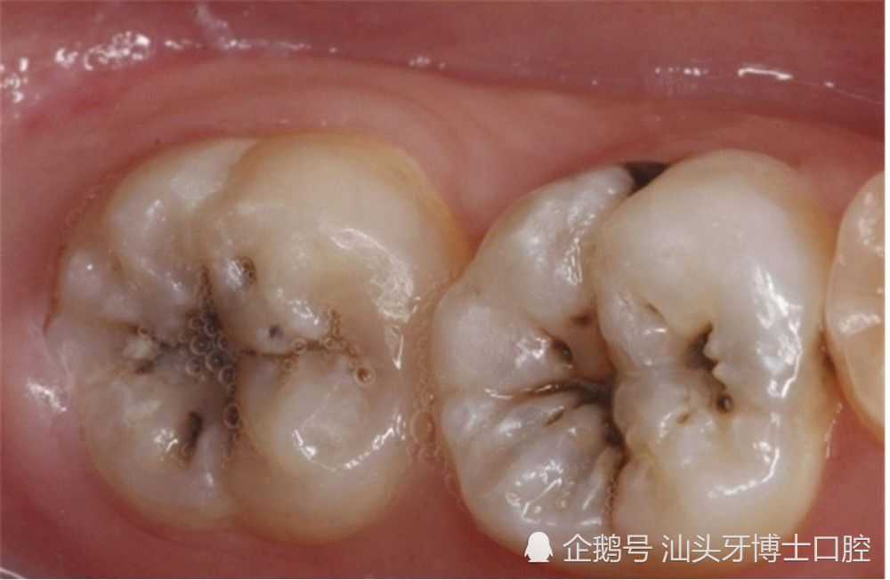 牙不疼也会有蛀牙!简单3步自查你有没有蛀牙
