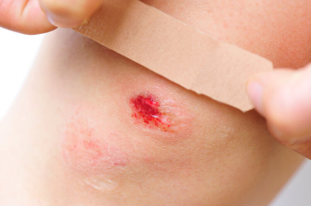 酒精碘伏碘酒双氧水破皮到底该涂哪个别再用错啦