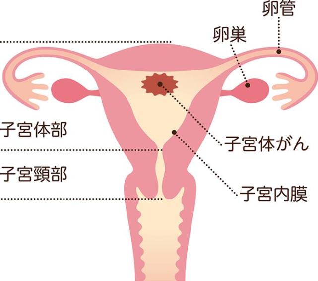 关于子宫体癌的详细解说 子宫体癌 子宫 肿瘤