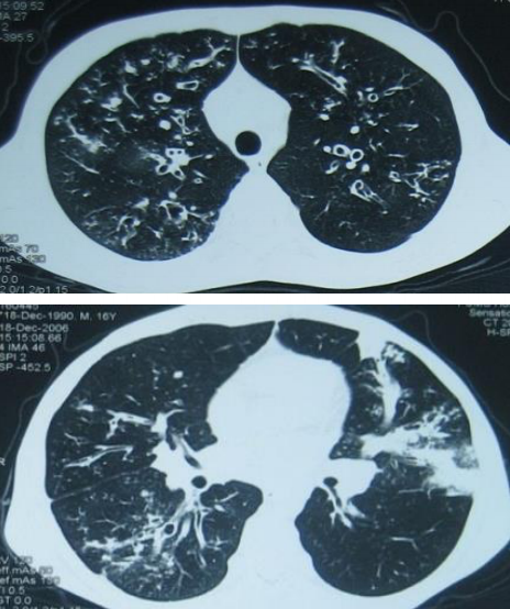 支气管扩张只是诊断的开始而不是结束从这5个经典病例看如何追溯支扩