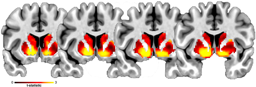 脑成像|PNAS：神经炎症破坏奖赏环路，脑成像可以预测儿童体重的增加