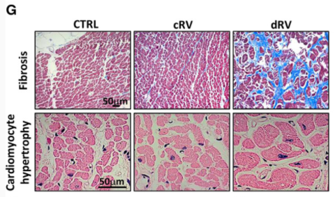 circulation肺动脉高压右心衰的新生物标志物长链非编码rnah19