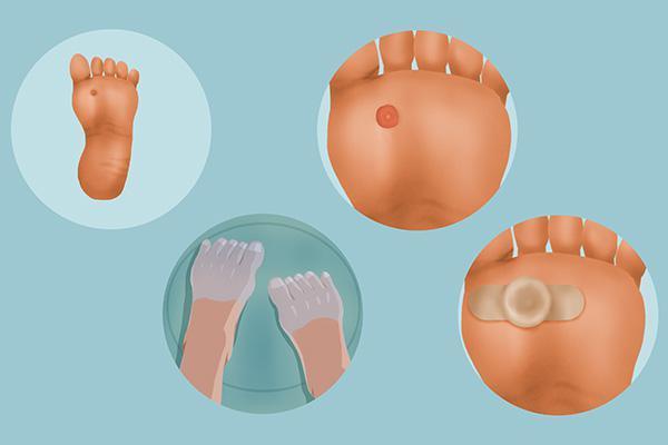 会长|为什么脚上会长出鸡眼？有什么方法能去除讨厌的鸡眼吗？