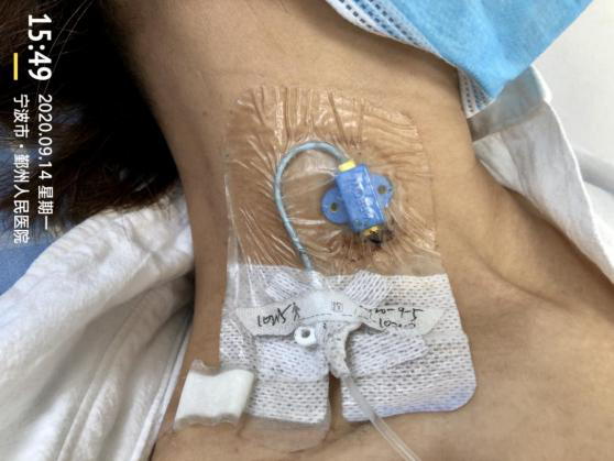 cvcpiccport有何区别怎么用3种输液法最全对比