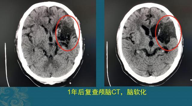 上面的颅脑ct片中,黑色部分就是脑细胞缺血坏死,脑组织化成水了,失去