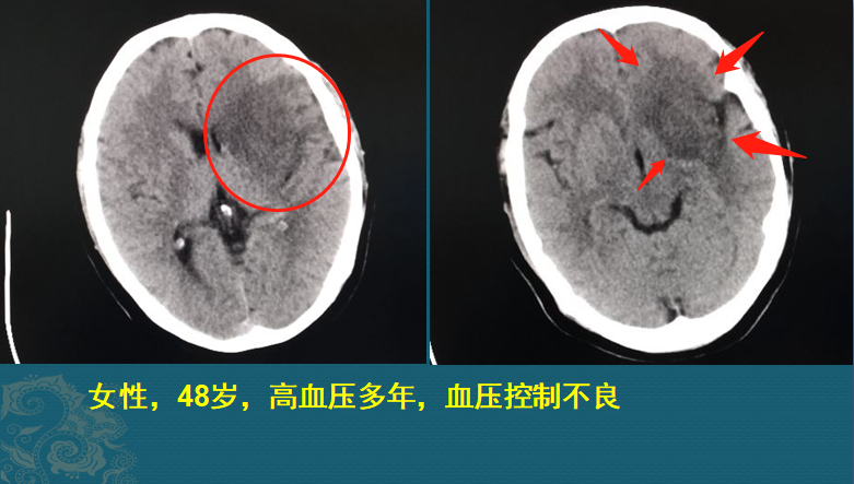 颅脑ct发现左侧大面积脑梗死