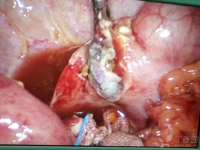 无法结扎的阑尾根部坏疽穿孔如何处理