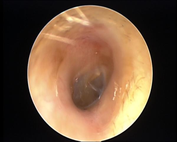吓人浙江小伙耳朵里布满密密麻麻白色绒毛物竟是因为