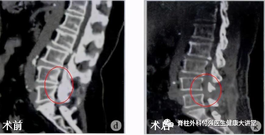 脊柱 管 狭窄 症 治療