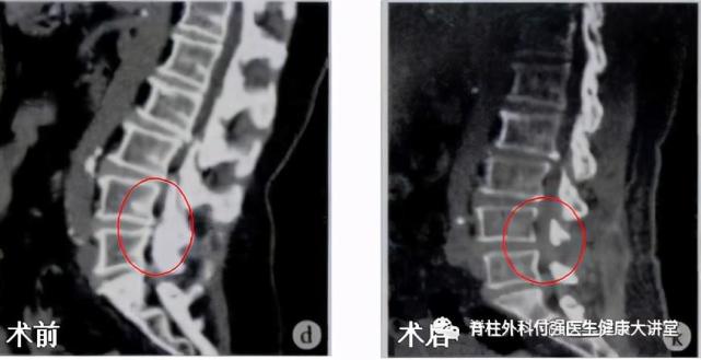 经皮内镜减压手术 微创治疗腰椎管狭窄症 腰椎间盘突出症 腰椎管狭窄症 脊柱外科 内镜