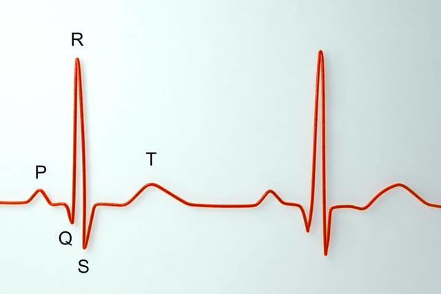 低血钾心电图表现图形图片