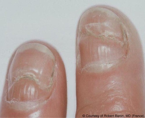 手指甲|月牙少是身体差？医生：指甲出现这4种异常，才是生病的信号！