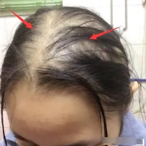 女孩子洗头时尽量改掉这3习惯否则变秃头女孩可别哭