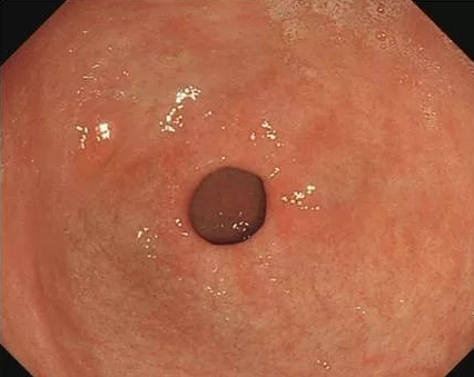 萎缩性胃炎|萎缩性胃炎能完全治愈？先要辨别清楚是生理性还是病理性的！