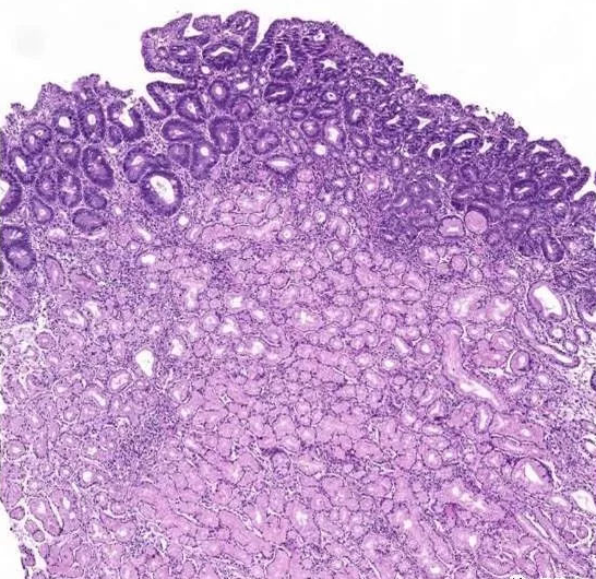 萎缩性胃炎|萎缩性胃炎能完全治愈？先要辨别清楚是生理性还是病理性的！