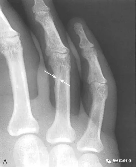 骨折线,从恰当的角度观察时,通常比骨骼中的正常线状影如滋养血管沟影