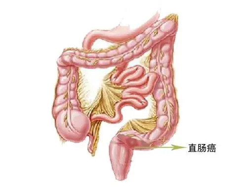 便秘血便不一定是痔瘡還有可能是直腸癌這種方法可以確診