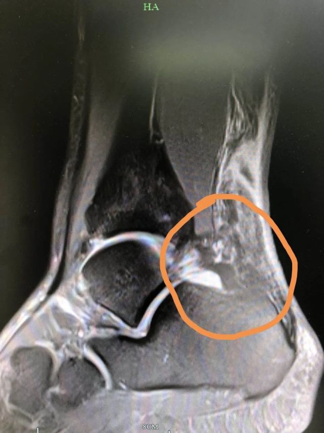 跟腱断裂的原因原来前段时间体检,小邵查出有脂肪肝,他开始运动减肥