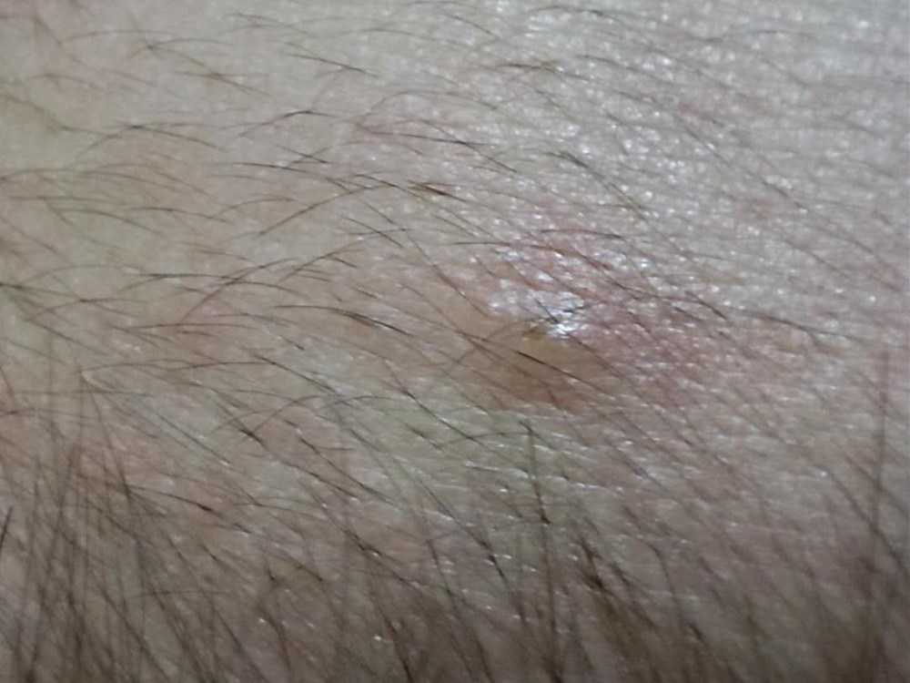 宝宝头上为什么会长痘痘呢?西安燕子月嫂