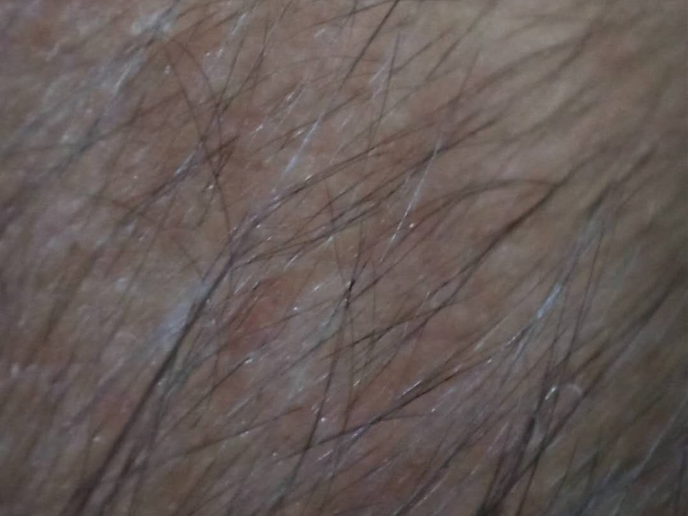 宝宝头上为什么会长痘痘呢?西安燕子月嫂