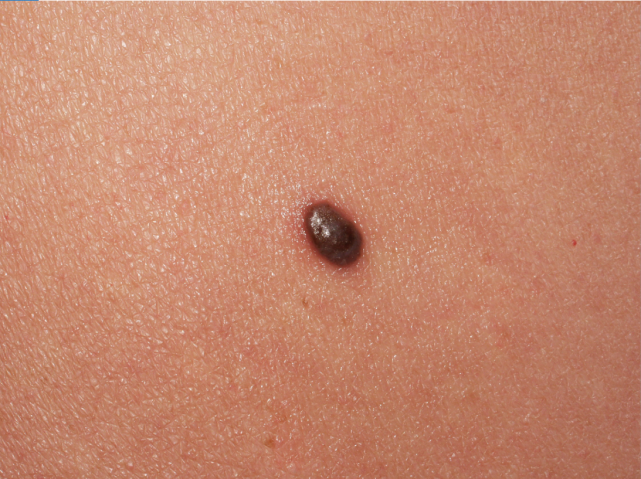 皮肤癌发生前身体会出现这2种症状早发现早救命