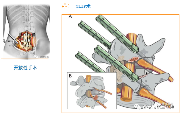 椎间孔注射方法步骤图片