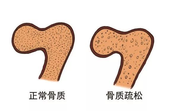 健康科普知识继发性骨质疏松症诊疗措施