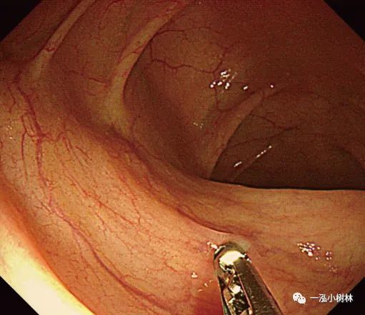 活检钳钳除肠息肉图片
