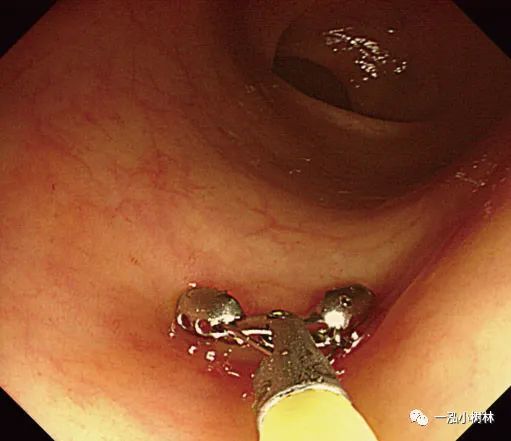 结肠息肉冷切除术
