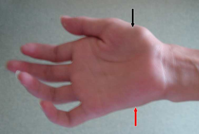 雷兵仔细查体见患者右手大鱼际,小鱼际肌及前臂尺侧肌肉均有萎缩,右手