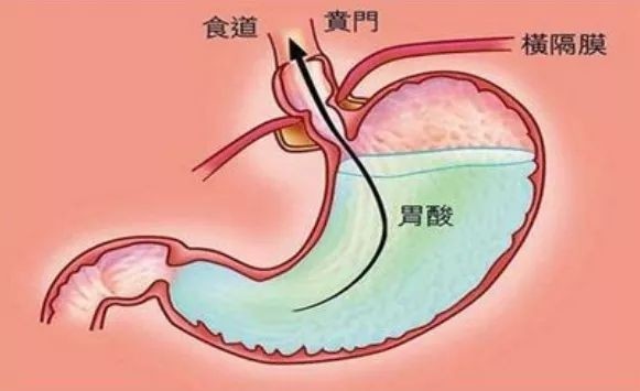 胃酸过多是什么原因,胃酸过多是什么原因怎样调理