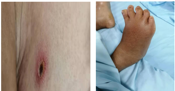 一农妇被小虫子咬伤,竟命悬一线