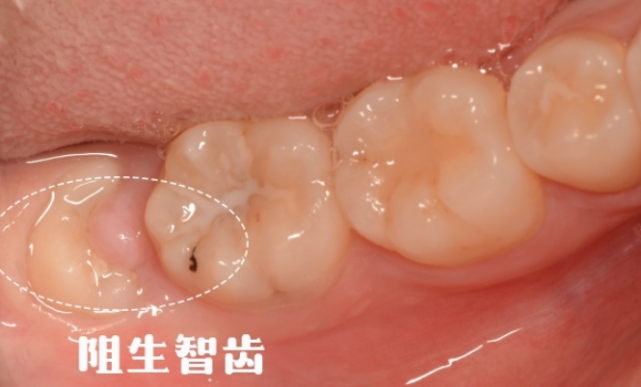也可能是由于智齿萌出过程中发生了阻生,远中牙龈覆盖形成盲袋,细菌