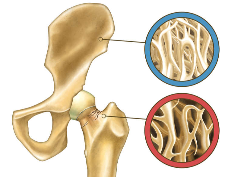 骨质疏松|世界骨质疏松日：骨质疏松危害大，预防可不止补钙这么简单！