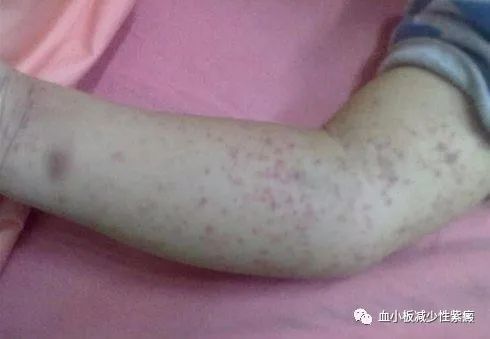 血小板减少性紫癜 腾讯网