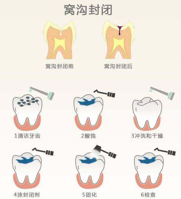 窩溝封閉為什麼要做