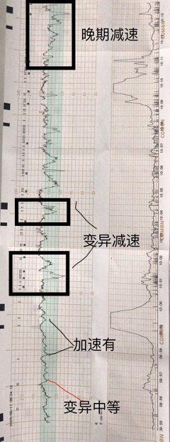 总体判读:宫缩目前 10 分钟 2 次,基线 155 次/分左右,有中等变异