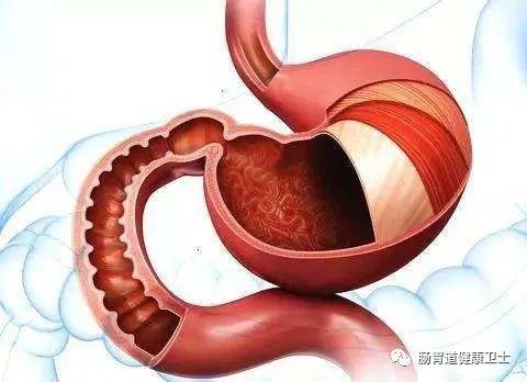 慢性非萎缩性胃炎|慢性非萎缩性胃炎到底是怎么回事？和慢性萎缩性胃炎有什么区别